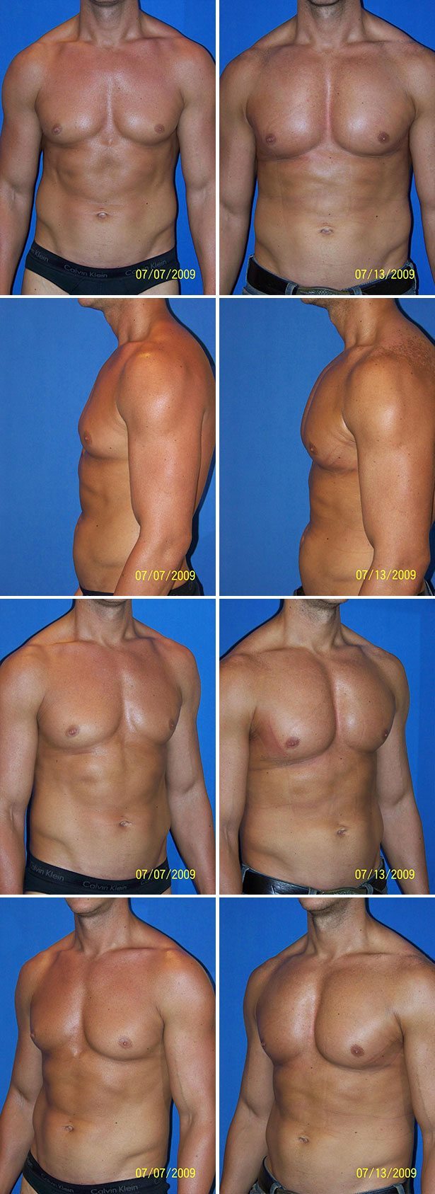 Before and After Image: Male Pectoral Implant - other