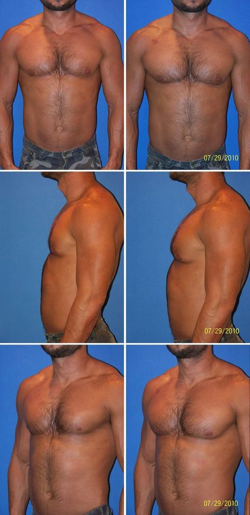 Before and After Image: Male Pectoral Implant - other