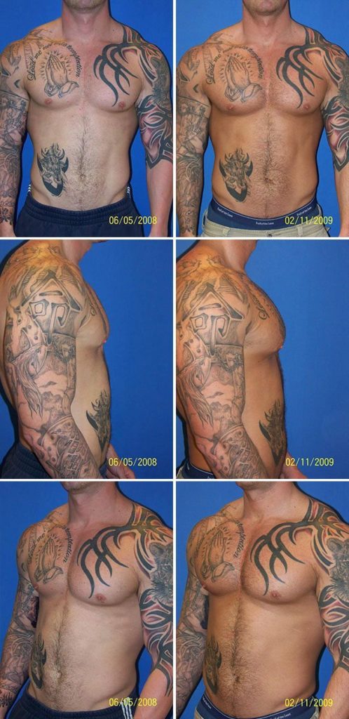 Before and After Image: Corrective Male Pectoral Implant - other
