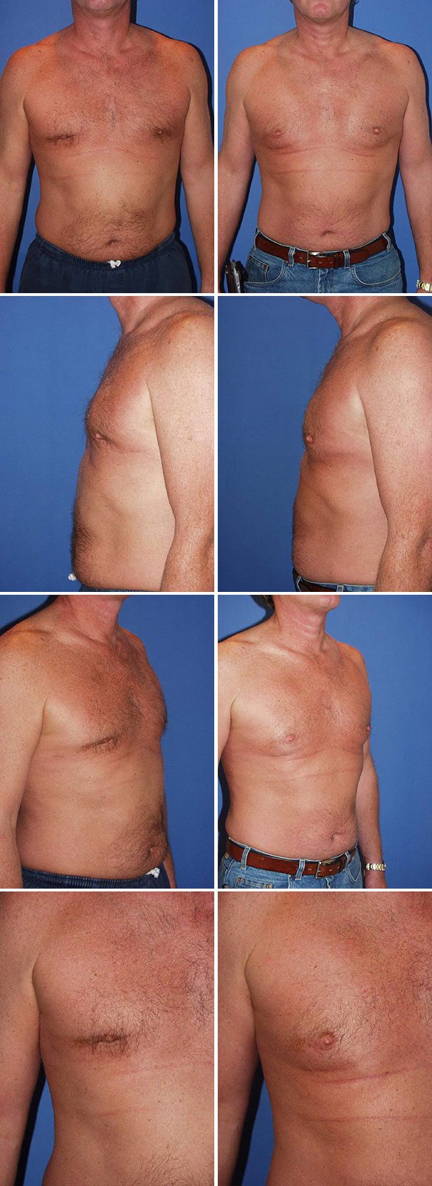 Before and After Image: Corrective Male Pectoral Implant - other