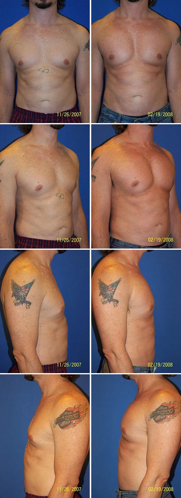 Before and After Image: Male Pectoral Implant - other