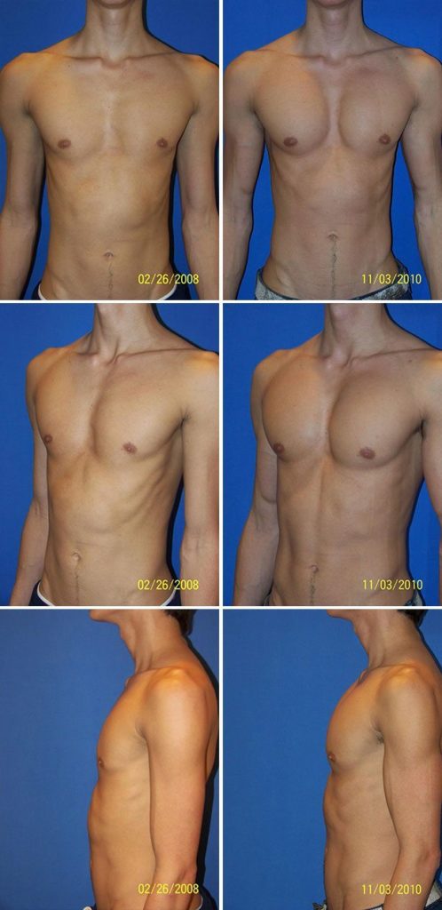 Before and After Image: Male Pectoral Implant - other