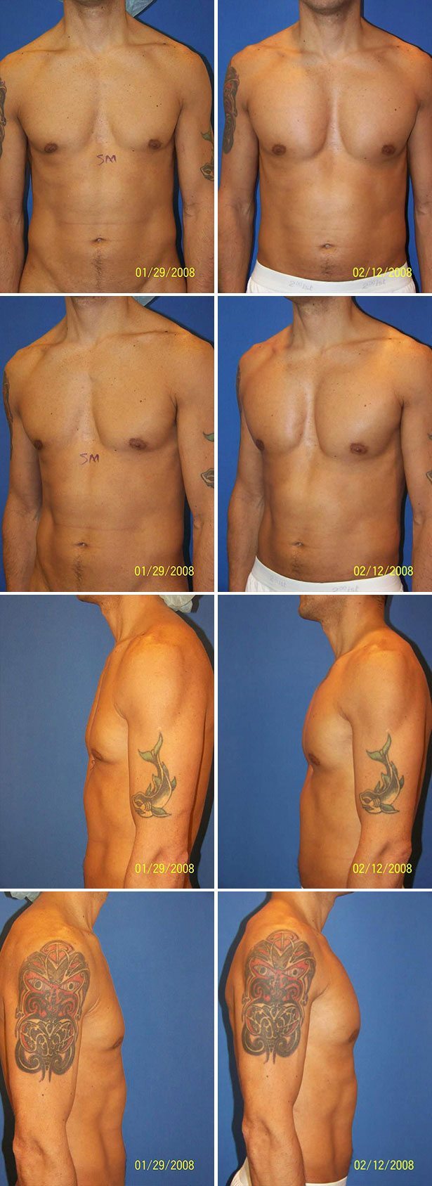 Before and After Image: Male Pectoral Implant - other