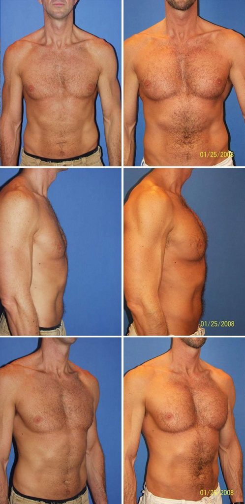 Before and After Image: Male Pectoral Implant - other