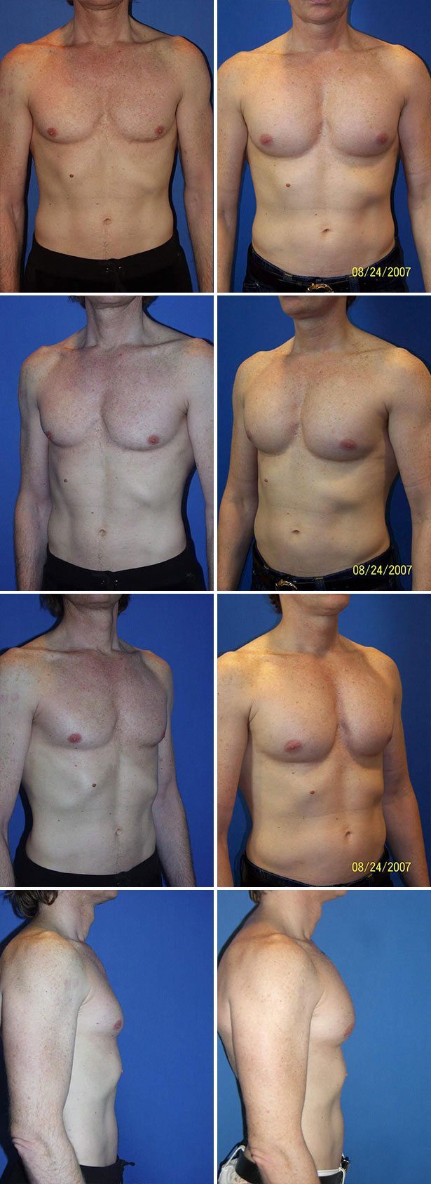 Before and After Image: Male Pectoral Implant - other