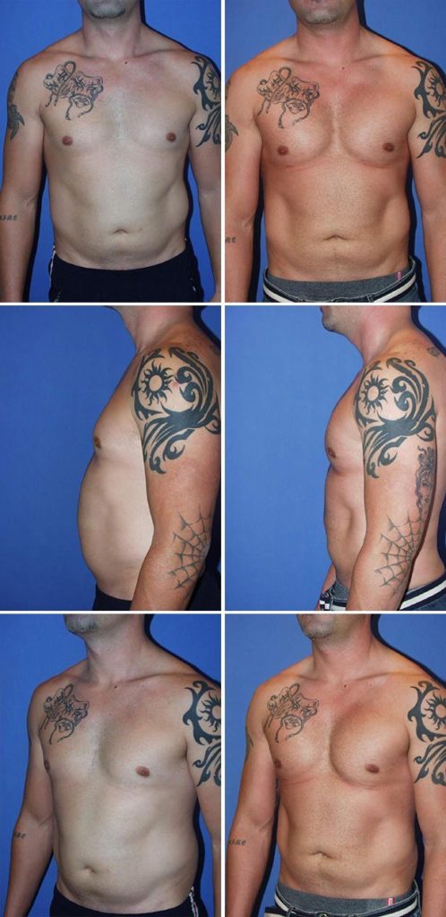 Before and After Image: Male Pectoral Implant - other