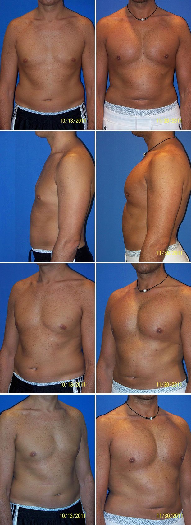 Before and After Image: Male Pectoral Implant - other