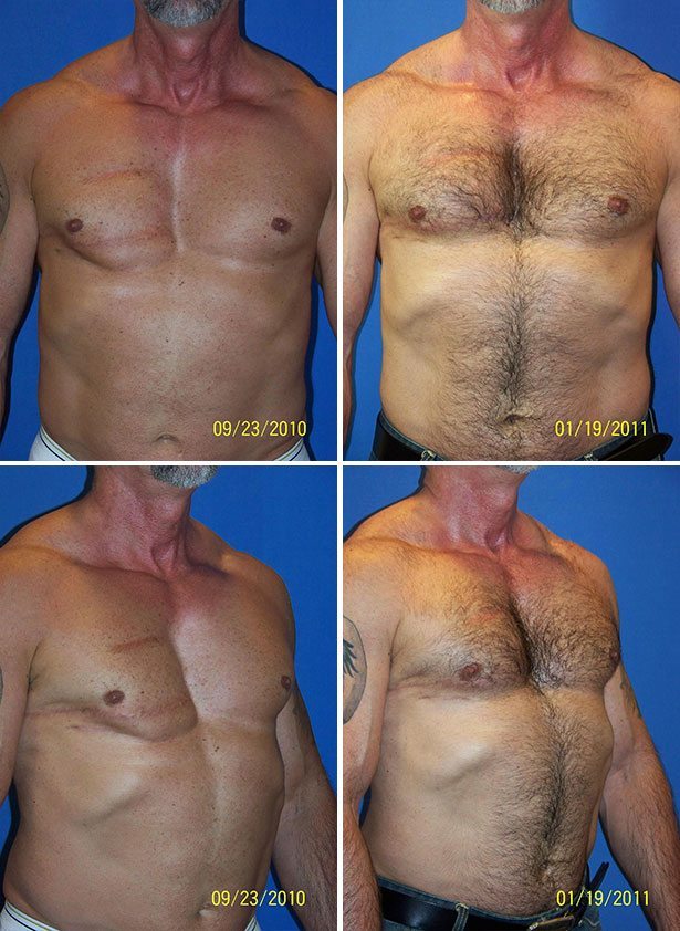 Before and After Image: Corrective Male Pectoral Implant - other