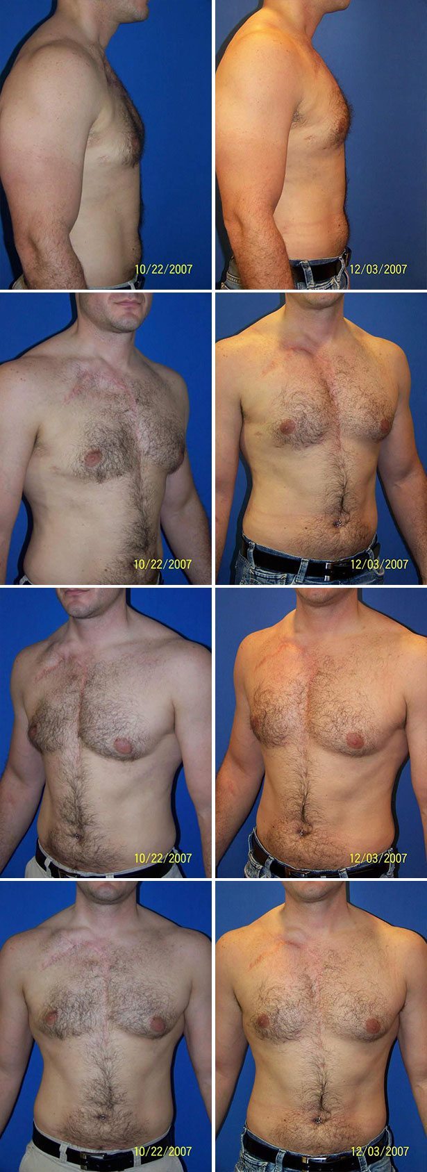 Before and After Image: Corrective Male Pectoral Implant - other