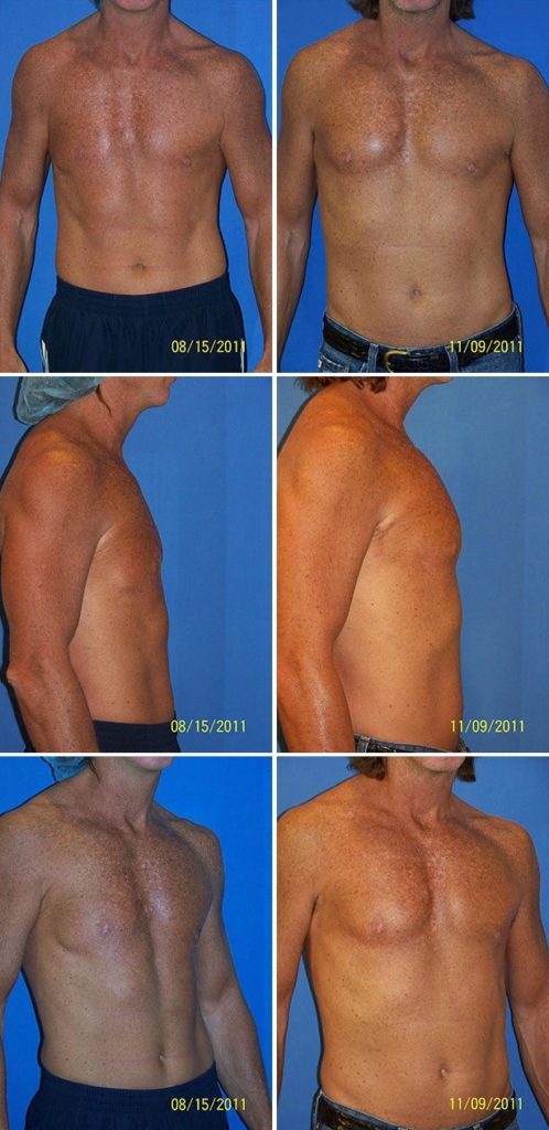 Before and After Image: Male Pectoral Implant - other