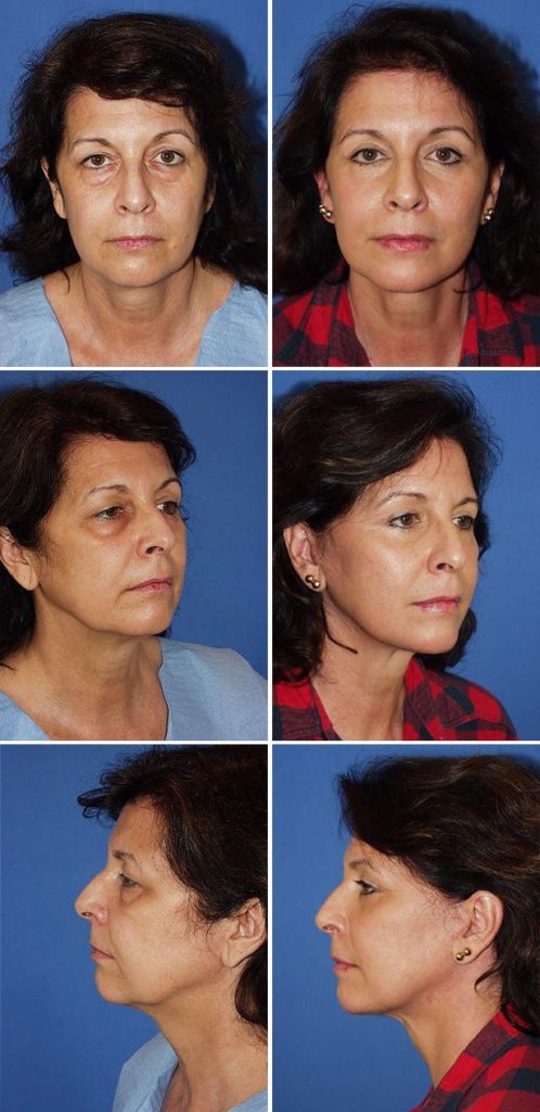 Before and After Image: Facelift Surgery - other