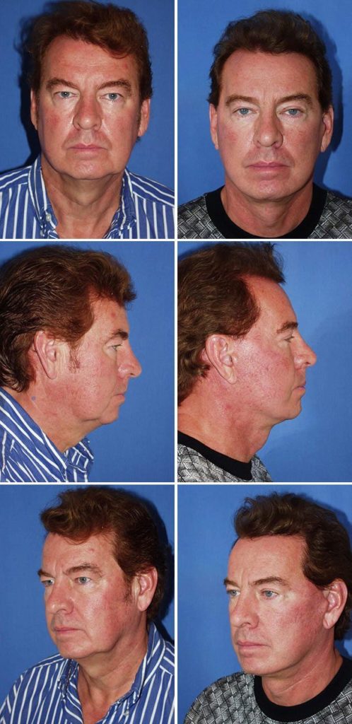 Before and After Image: Facelift Surgery - other