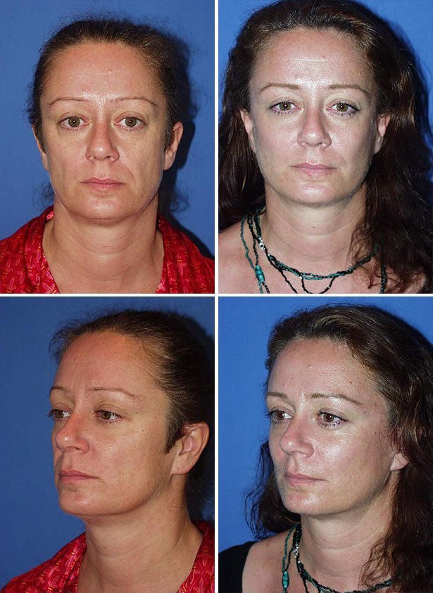 Before and After Image: Facelift Surgery - other