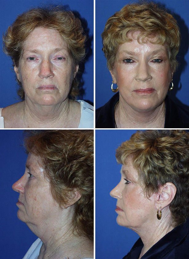 Before and After Image: Facelift Surgery - other