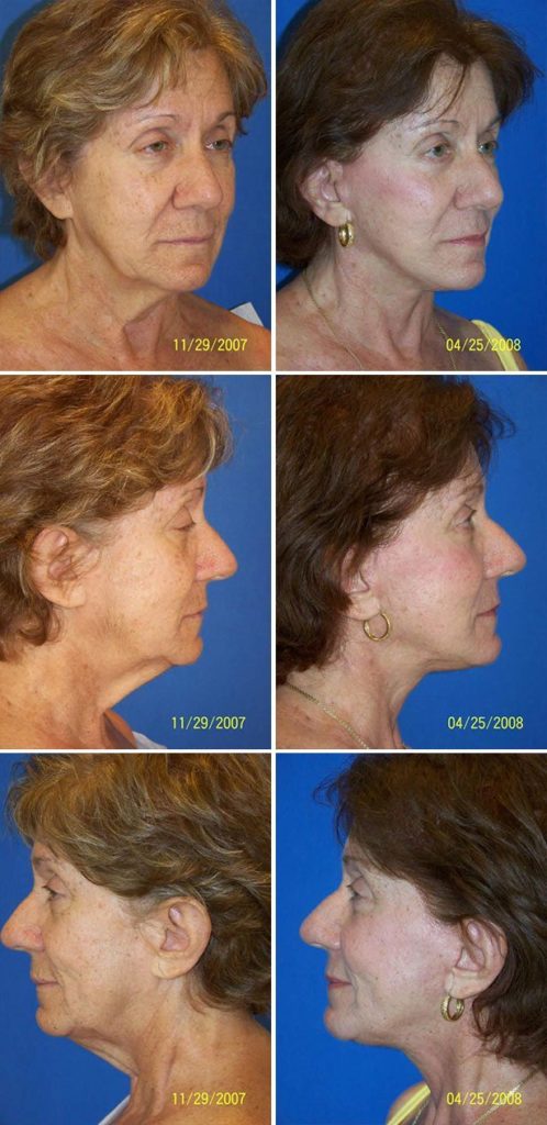 Before and After Image: Facelift Surgery - other