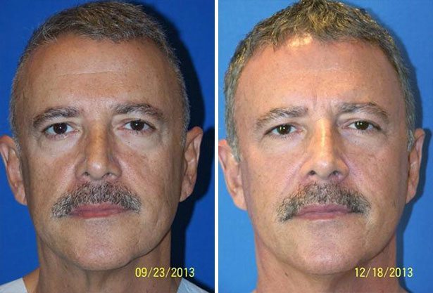 Before and After Image: Facial Rejuvenation and Fat Grafting - front