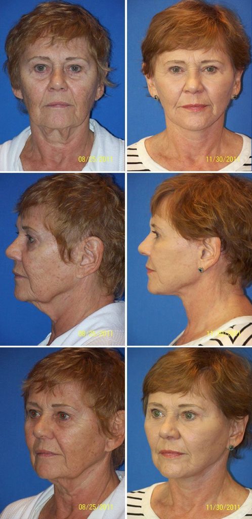 Before and After Image: Facelift Surgery - other