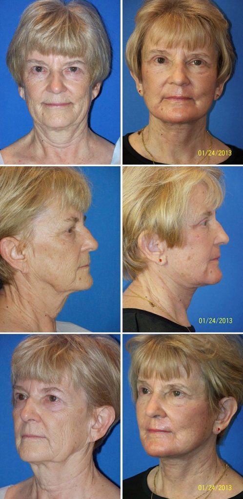 Before and After Image: Facelift Surgery - other
