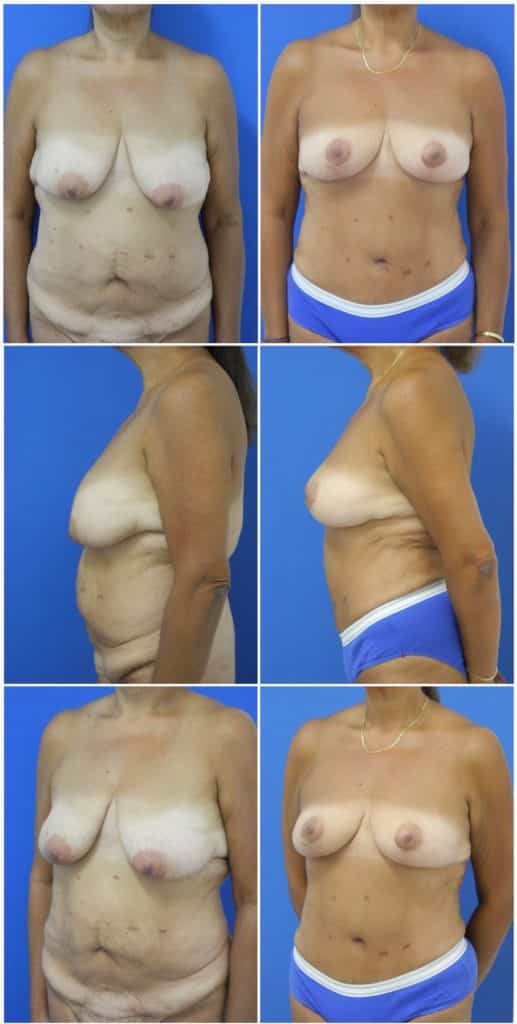 Before and After Image: Tummy Tuck (Abdominoplasty) - other
