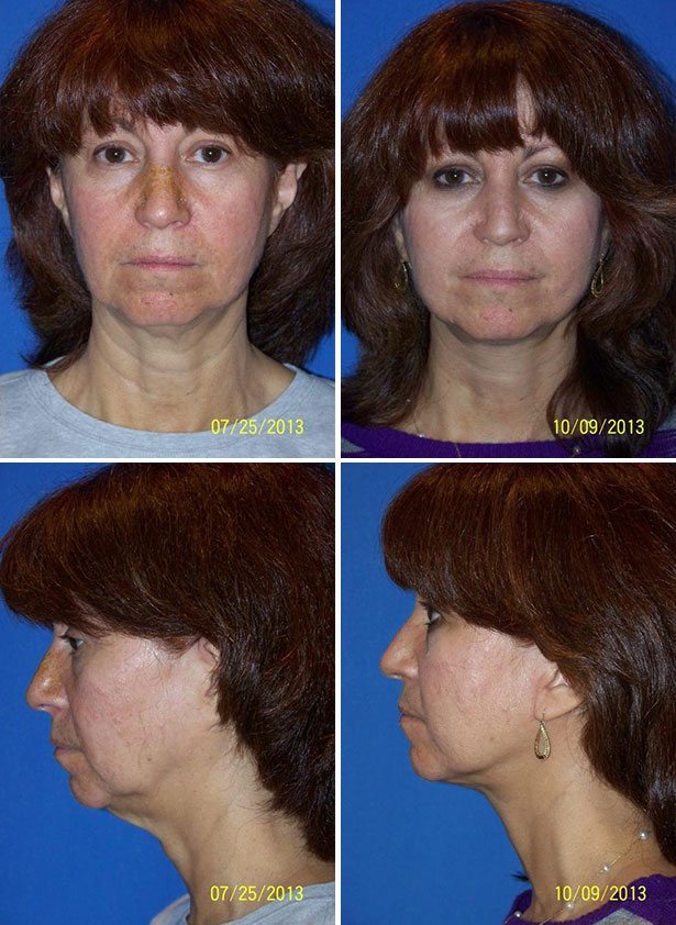 Before and After Image: Neck Lift Surgery - other