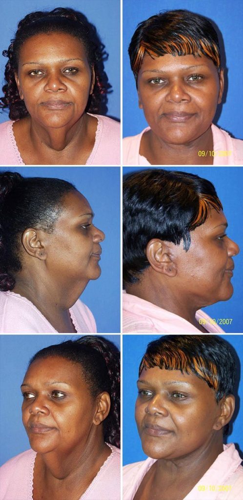 Before and After Image: Neck Lift Surgery - other
