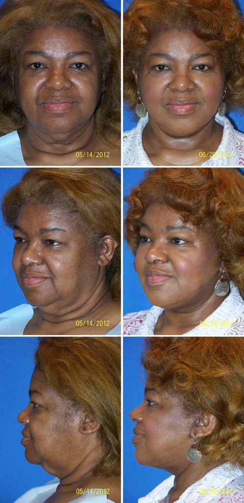 Before and After Image: Neck Lift Surgery - other