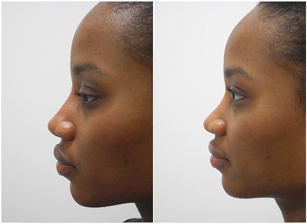 Before and After Image: Non-Surgical Rhinoplasty - left-side