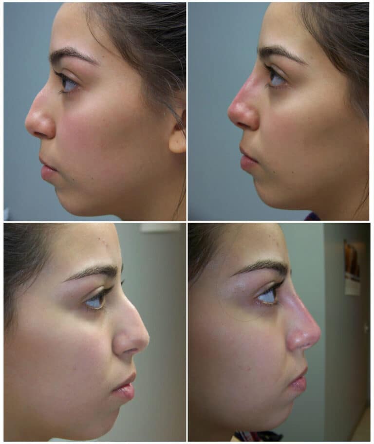 Before and After Image: Non-Surgical Rhinoplasty - other