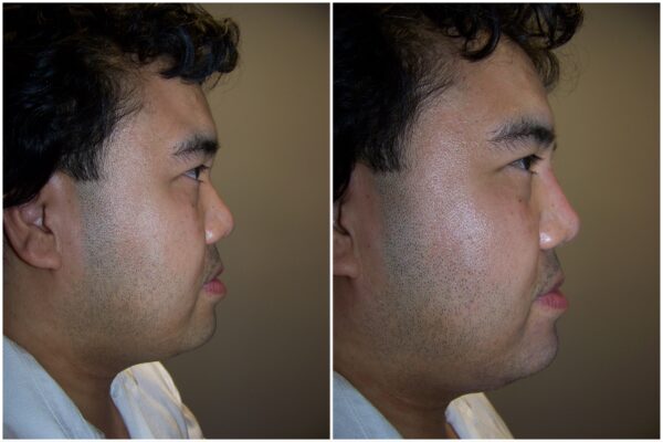 Before and After Image: Non-Surgical Rhinoplasty - right-side