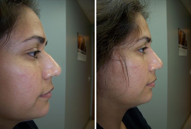 Before and After Image: Non-Surgical Rhinoplasty - right-side