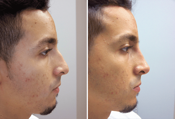 Before and After Image: Non-Surgical Rhinoplasty - right-side