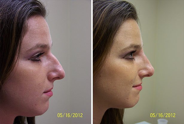 Before and After Image: Non-Surgical Rhinoplasty - right-side