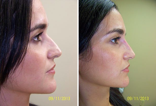 Before and After Image: Non-Surgical Rhinoplasty - right-side