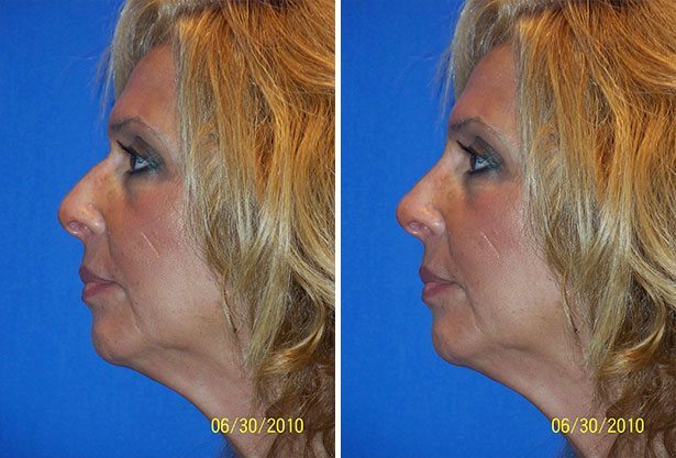 Before and After Image: Non-Surgical Rhinoplasty - left-side