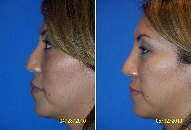 Before and After Image: Non-Surgical Rhinoplasty - left-side