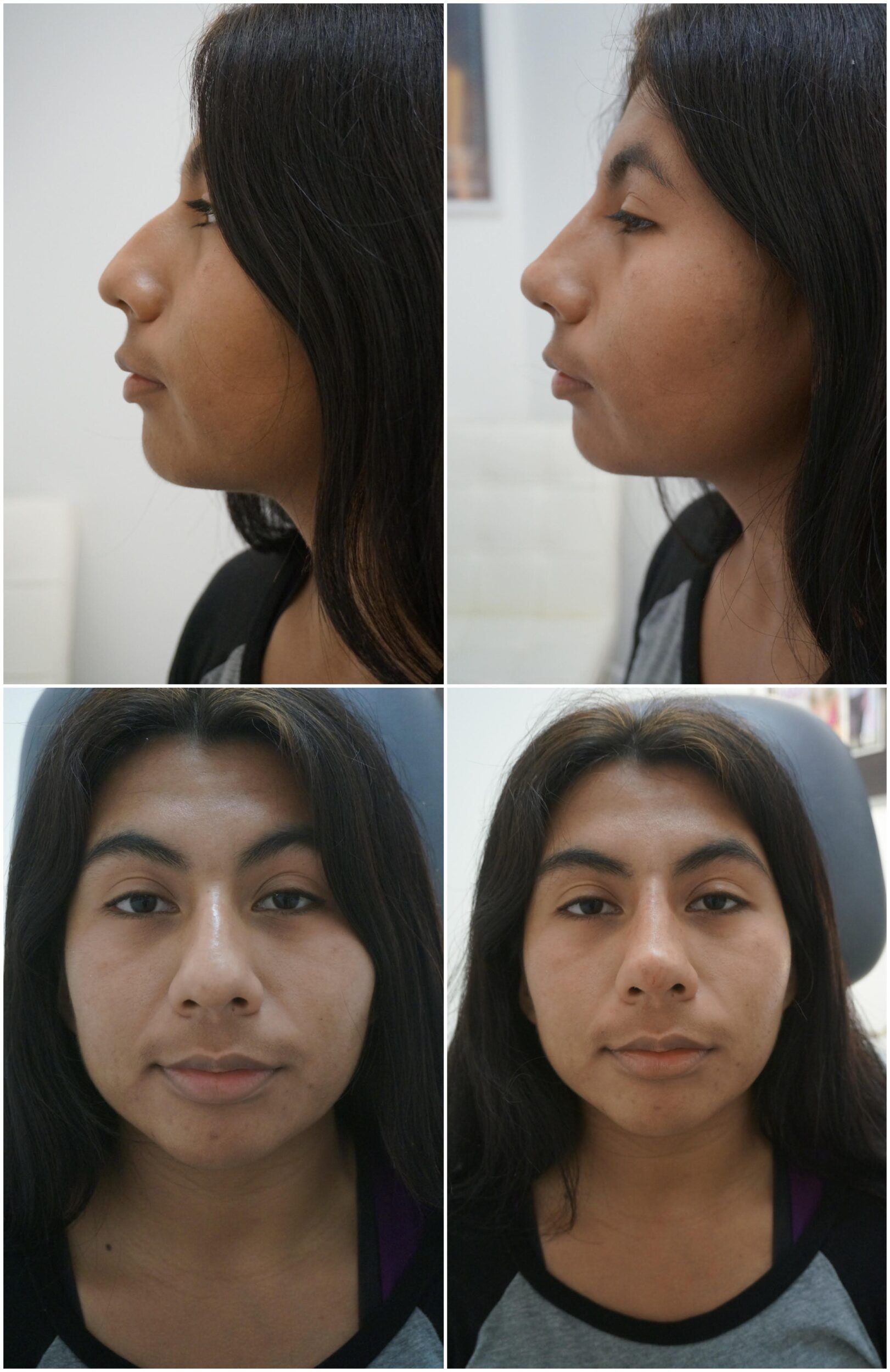 Before and After Image: Non-Surgical Rhinoplasty - other