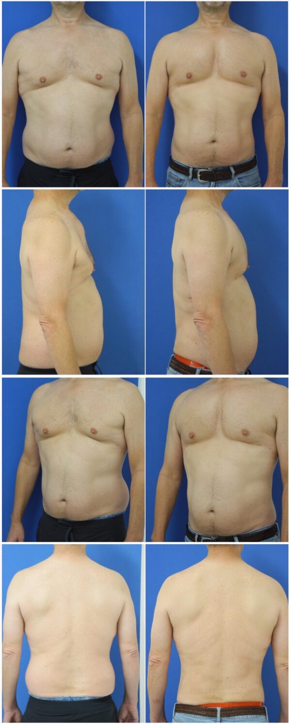 Before and After Image: Male Pec Implant - other