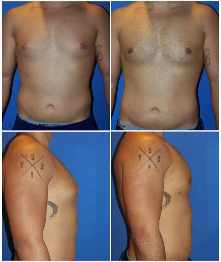Before and After Image: Male Pec Implant - other