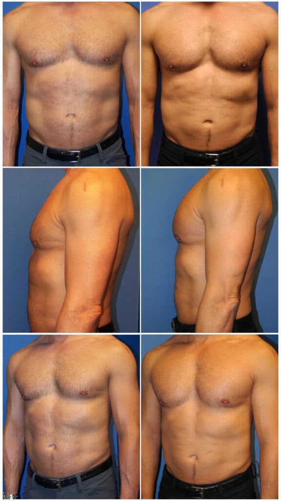 Before and After Image: Male Pec Implant - other