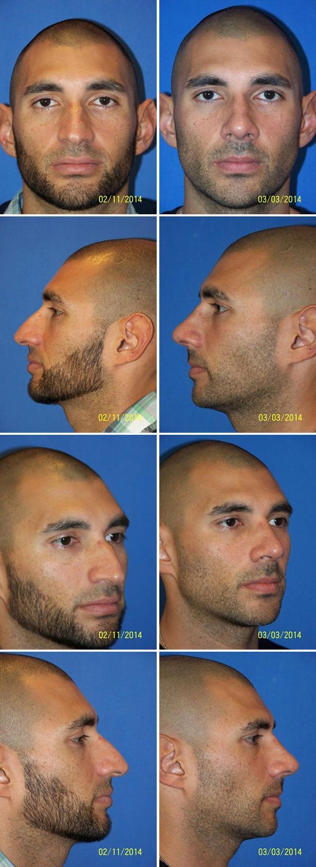 Before and After Image: Rhinoplasty - other