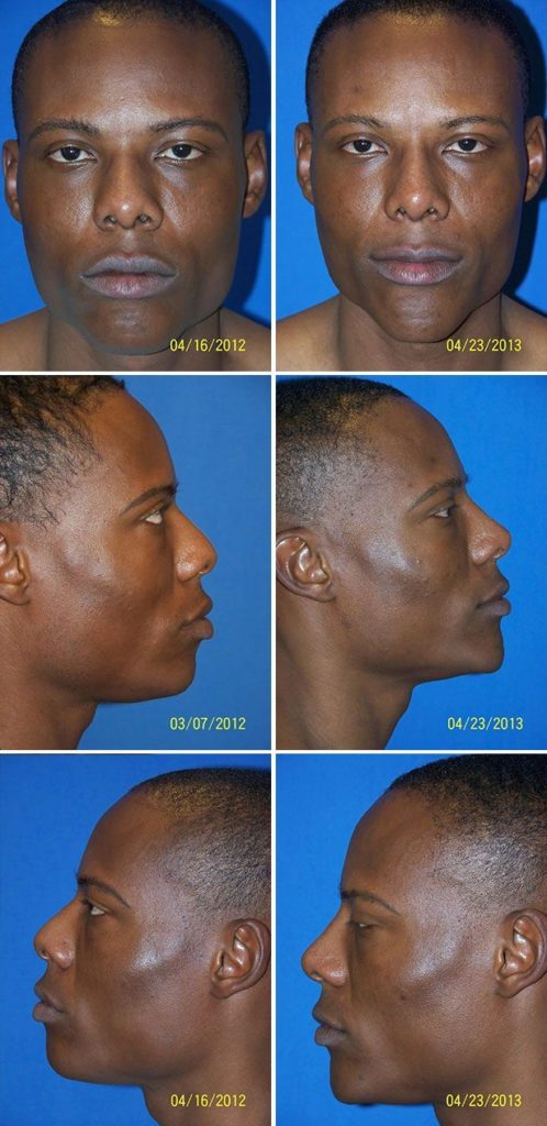 Before and After Image: Chin Augmentation Surgery - other