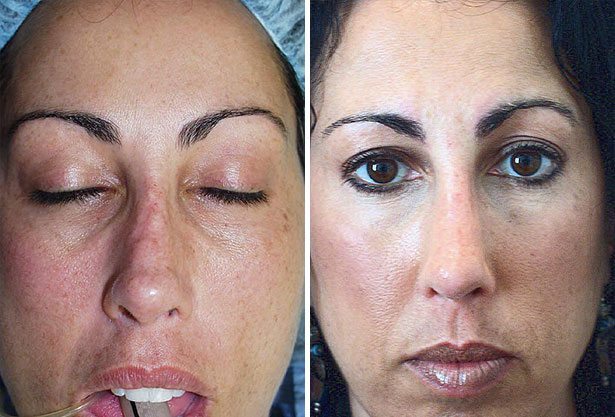 Before and After Image: Rhinoplasty - other