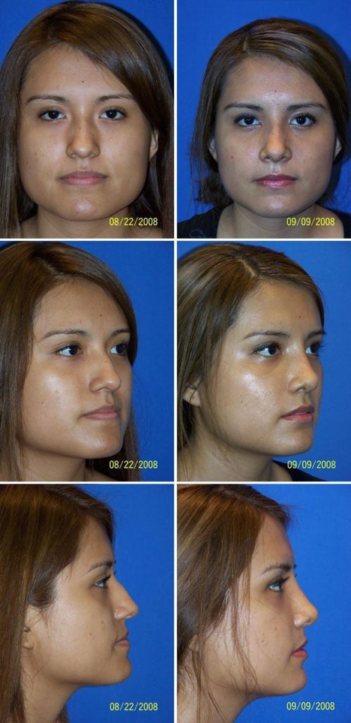 Before and After Image: Rhinoplasty - other