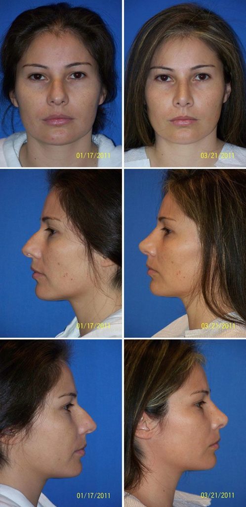 Before and After Image: Rhinoplasty - other