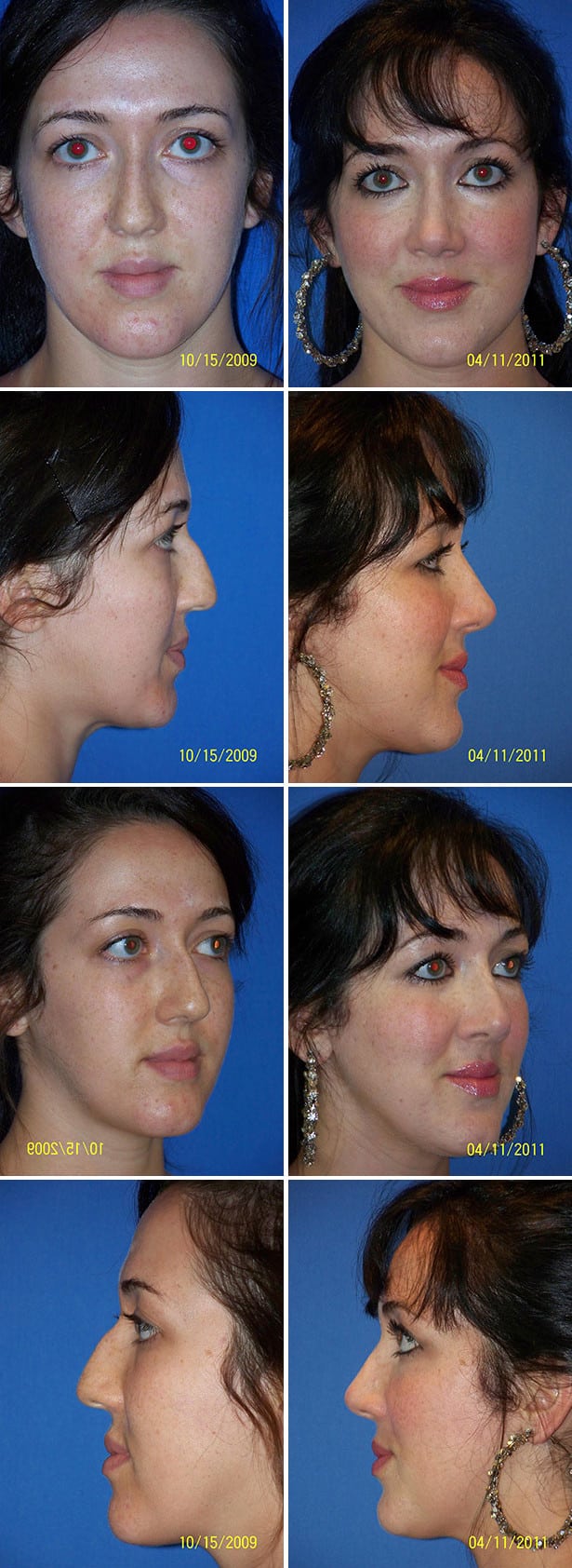 Before and After Image: Rhinoplasty - other