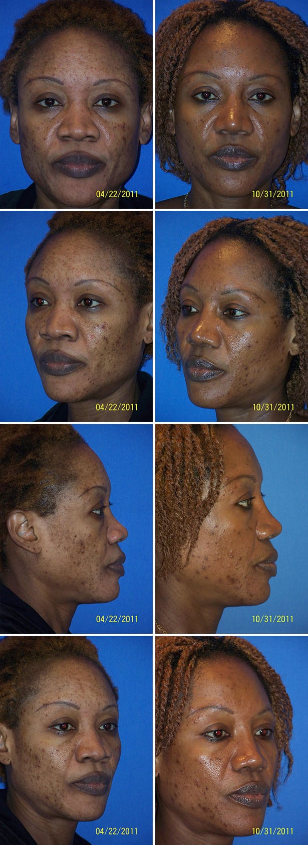 Before and After Image: Rhinoplasty - other