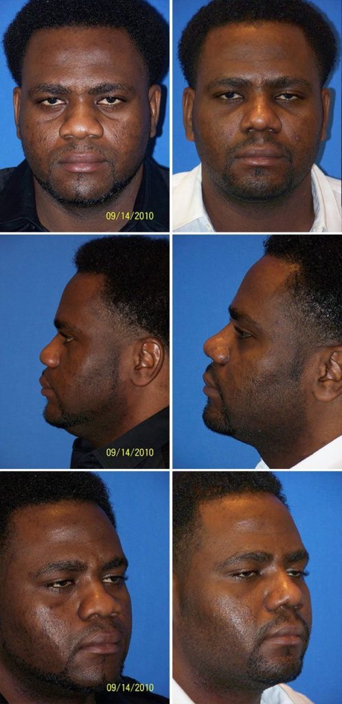 Before and After Image: Rhinoplasty - other