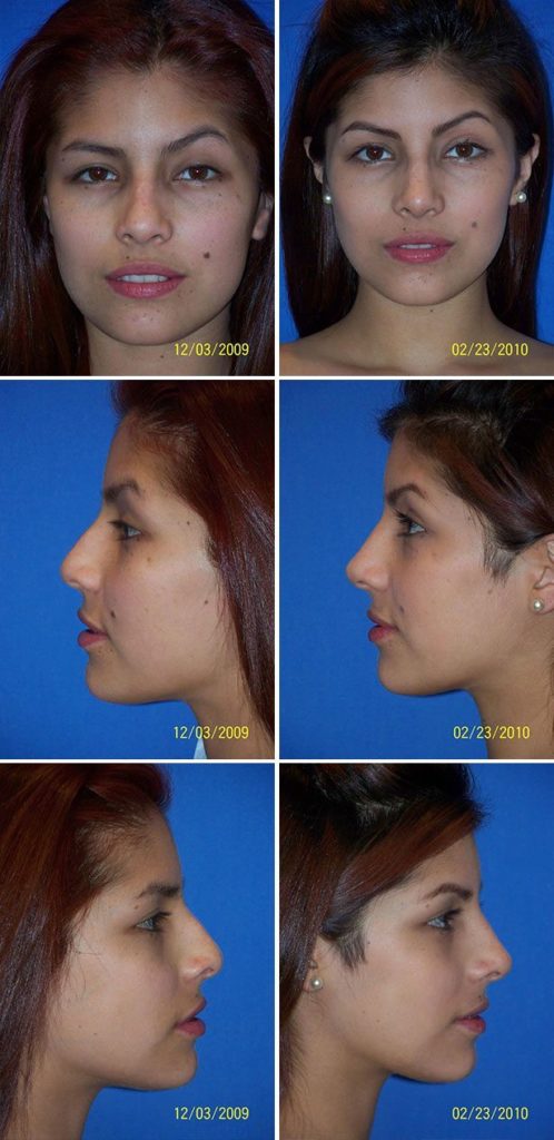 Before and After Image: Rhinoplasty - other