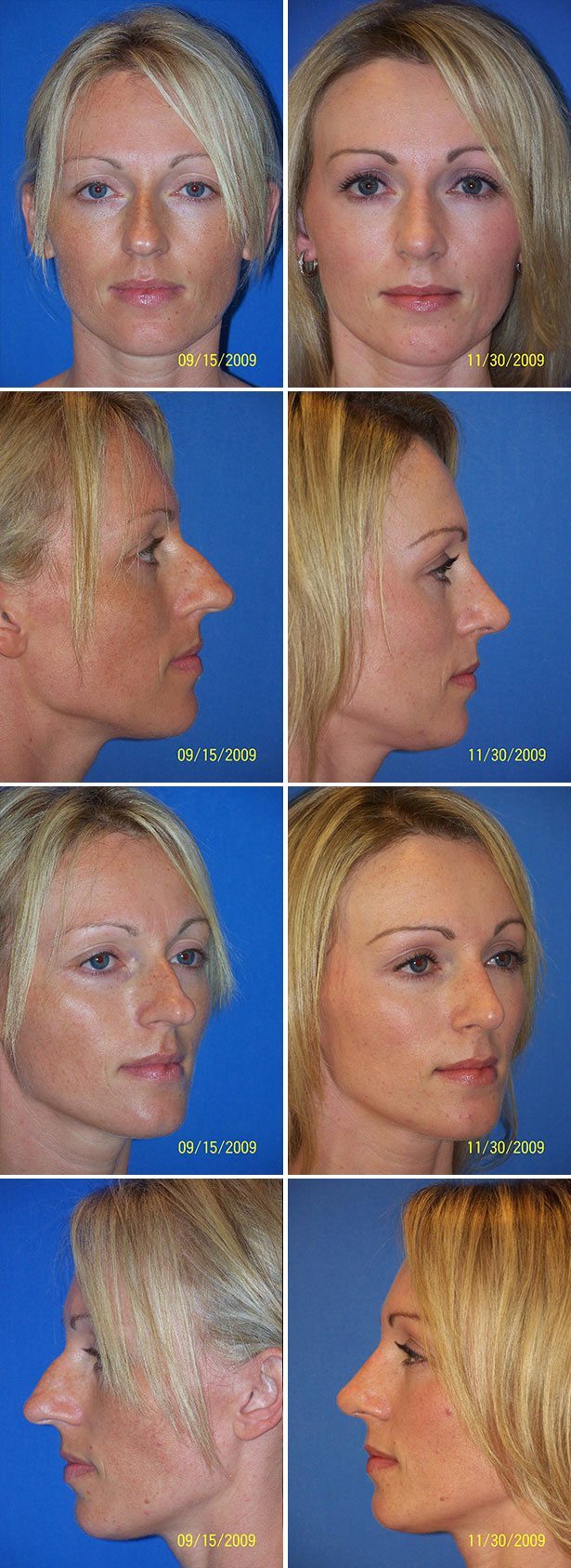 Before and After Image: Rhinoplasty - other