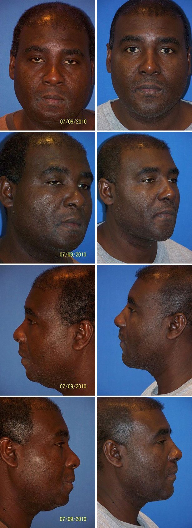 Before and After Image: Rhinoplasty - other